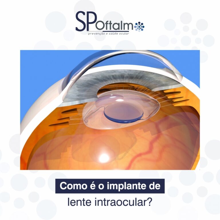 Como é o implante de lente intraocular?